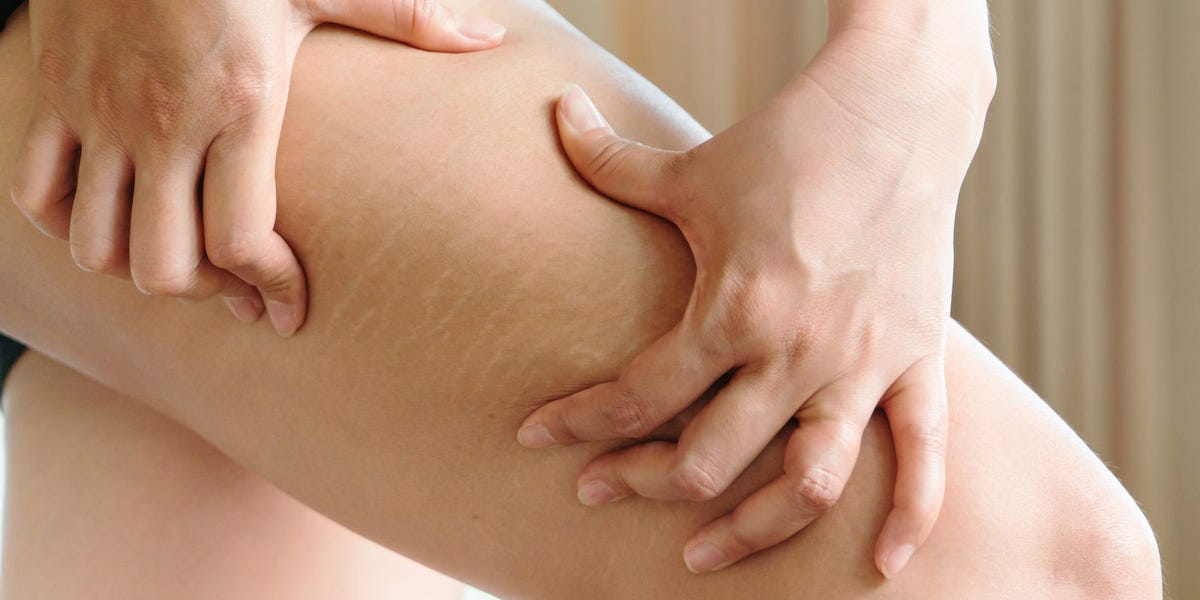 Stretch Marks / Birth Marks