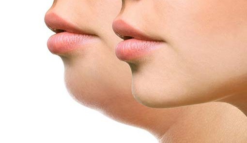 Double Chin Removal